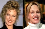 melanie-griffith-plastic-surgery