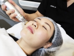 Astute Clinic’s Flawless Skin Laser Treatment Uses Sylfirm Technology To Reduce Rosacea & Melasma